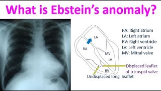 What is Ebstein’s anomaly [upl. by Delanie77]