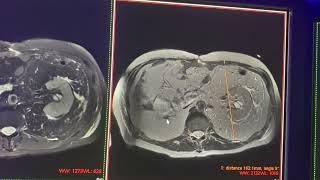 Mielolipoma vs lipoma perirrenal gigante vs liposarcoma retroperitoneal [upl. by Ajed]