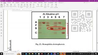 Hemoglobin Electrophoresis amp G6PD test  Medical Biochemistrry [upl. by Tedder]