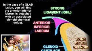 Lesions Of The Shoulder GLAD Lesion  Everything You Need To Know  Dr Nabil Ebraheim [upl. by Akehsay]