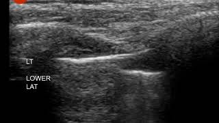 Pneumothorax  ultrasound  Lung Point [upl. by Suellen]