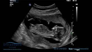 Scan of the Week 15 Weeks Pregnant The Advanced Early Ultrasound [upl. by Ymmaj]