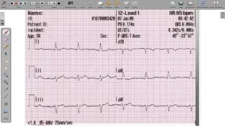 ECG 12 Lead Axis Deviation [upl. by Geoffrey]