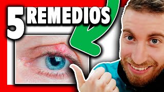 🔴 ¿Cómo CURAR un CHALAZION en el ojo ¿Manzanilla [upl. by Willem]