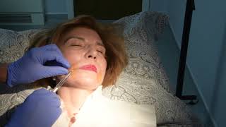 Juvederm injections to nasolabial folds [upl. by Norag]