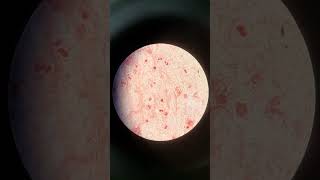 Gram Staining of Sputum Abundant Pus Cells with Absence of Microbial Involvement [upl. by Aivilys602]