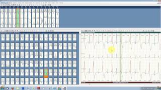 Typcial ECG analysis with ECGpro Holter 743 [upl. by Meeharb]