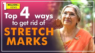 How to get rid of stretch marks  Dr Hansaji Yogendra [upl. by Neelahtak]