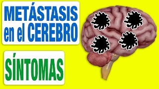 Todos los Síntomas de las Metástasis en el Cerebro [upl. by Aicilaf750]