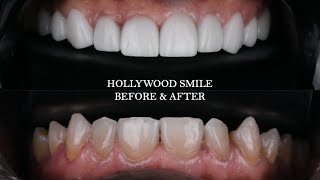 Perfect Hollywood Smile Before and After Results [upl. by Polash]