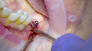 Removal of an infected Dental Implant [upl. by Amble301]