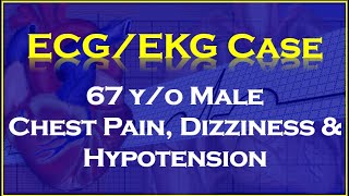 ECGEKG Case Review 67 yo male with chest pain diaphoresis and hypotension [upl. by Almeida417]