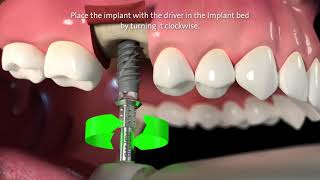 Straumann® TLX Implant System Step by Step Video [upl. by Ellata]