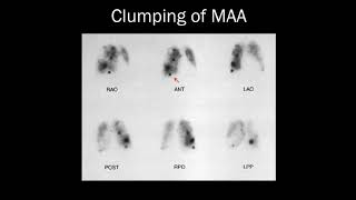 VQ Simplified Criteria for the OnCall Radiologist  15 Minute Radiology CME [upl. by Linders]