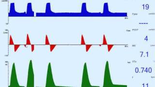 Patient Ventilator Asynchrony Trigger Delay [upl. by Julide]