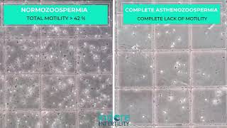 Complete Asthenozoospermia or Necrozoospermia  Sample under microscope  Compared with Normal [upl. by Akehsyt]