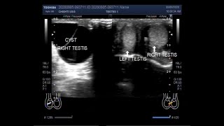 Ultrasound Video showing Epididymal Cyst in a child of about five months [upl. by Niliac790]