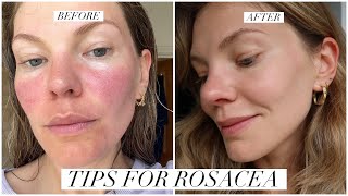 Rosacea 4 skincare products amp treatments that work [upl. by Aneroc613]