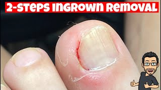 HOW TO REMOVE AN INGROWN TOENAIL [upl. by Osswald]