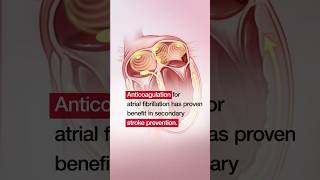 Apixaban to Prevent Recurrence After Cryptogenic Stroke in Patients With Atrial Cardiopathy [upl. by Zeuqram]