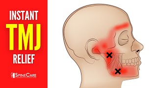 How to Relieve TMJ Pain at Home  30 SECOND RELIEF [upl. by Scheld106]