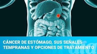 Cáncer de estómago sus señales tempranas y opciones de tratamiento [upl. by Nikoletta]