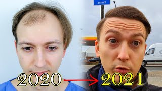 FUE Hair Transplant Growth Timeline  Before amp After [upl. by Mischa]