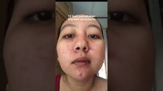 Review Wardah Acnederm Part1 [upl. by Bud973]