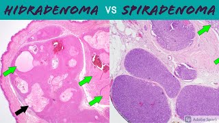 Hidradenoma Acrospiroma vs SpiradenomaCylindroma 5Minute Pathology Pearls [upl. by Snah668]