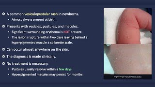 Transient Neonatal Pustular Melanosis [upl. by Neeruan]