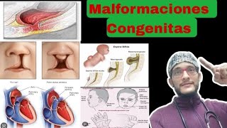 MALFORMACIONES CONGENITAS SINDROME DE DOWN PALADAR Y LABIO HENDIDO [upl. by Bakemeier]