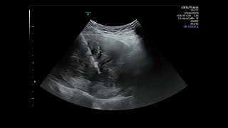 Ultrasound guided microwave ablation for uterine myoma [upl. by Enautna]