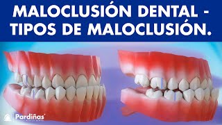 Maloclusión  ¿Cómo es la forma de correcta de la mordida  Tipos de maloclusiones dentales © [upl. by Eniarol]