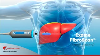 Como é feito o exame FibroScan  Clínica Hepatogastro [upl. by Namus]