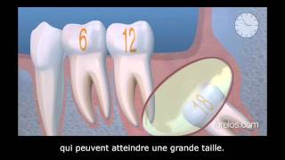 Les troisièmes molaires ou dents de sagesse [upl. by Brentt]