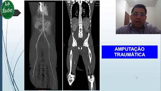 Angiotomografia de aorta e MMII CASOS [upl. by Artinak]