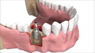 How DENTAL IMPLANTS are inserted  3D simulation [upl. by Eetak330]