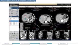 Philips IntelliSpace Portal 70 clinical application MMTT Multi Modality Tumor Tracking [upl. by Lyrrad]