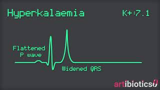 Hyperkalaemia ECG changes animated [upl. by Saibot]