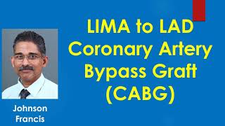 LIMA to LAD Coronary Artery Bypass Graft CABG [upl. by Yekcaj]