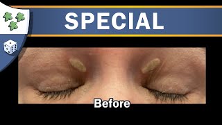 Ryan did a thing Episode 3 SelfSurgery Xanthelasma removal with Wartner Pen [upl. by Star]