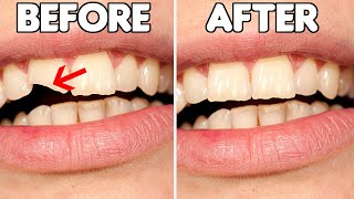 How To FIX A Chipped Tooth Broken Tooth Repair Options [upl. by Enomrej]