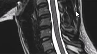 How to read and MRI of the cervical spine  First Look MRI [upl. by Barnett]