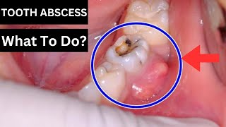 How To Treat A Tooth Abscess [upl. by Yeleek]