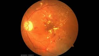 Fundoscopic images of Diabetic Retinopathy [upl. by Nnelg]