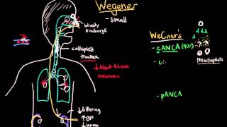 Wegener and Microscopic Polyangiitis [upl. by Lassiter386]