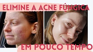 Rotina de Skincare COMPLETA para Eliminar a ACNE FÚNGICA  Ingredientes ativos e como usar ⚠️ [upl. by Vasilis568]