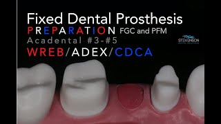 Fixed Dental Prosthesis Preparation  35 Acadental  WREBADEXCDCA [upl. by Duhl]