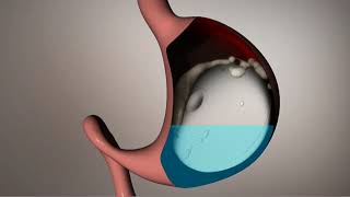 The Allurion Swallowable Gastric Balloon  How it works [upl. by Ardien]