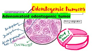 Adenomatoid odontogenic tumor HISTOPATHOLOGYradiographic featuresclinical featuresTreatment [upl. by Aihtekal]